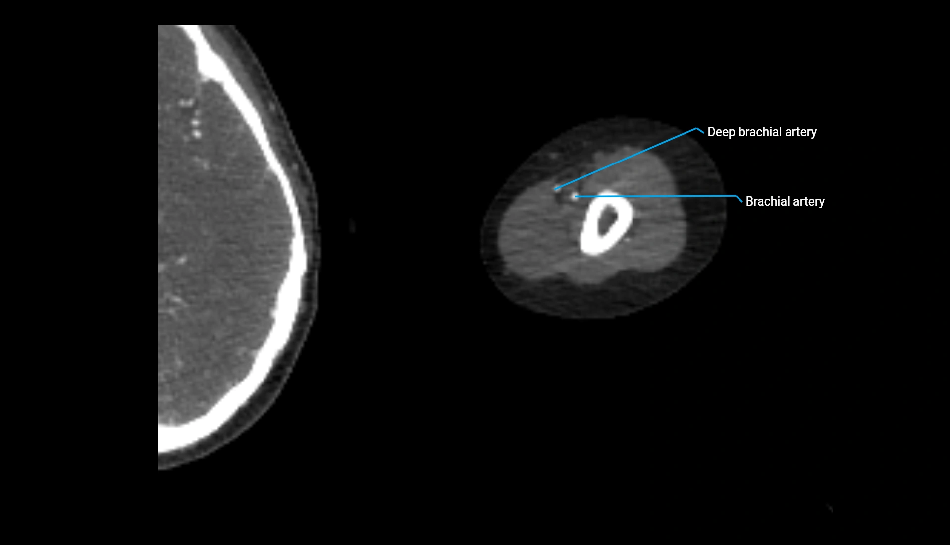 CTA upper limb axial cross sectional anatomy labelled image 250 (2).webp